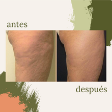 Cargar imagen en el visor de la galería, Celulitis y Reafirmación