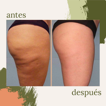 Cargar imagen en el visor de la galería, Celulitis y Reafirmación